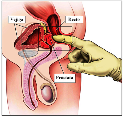 Centro andrológico Recoleta – Agrandamiento de la Próstata